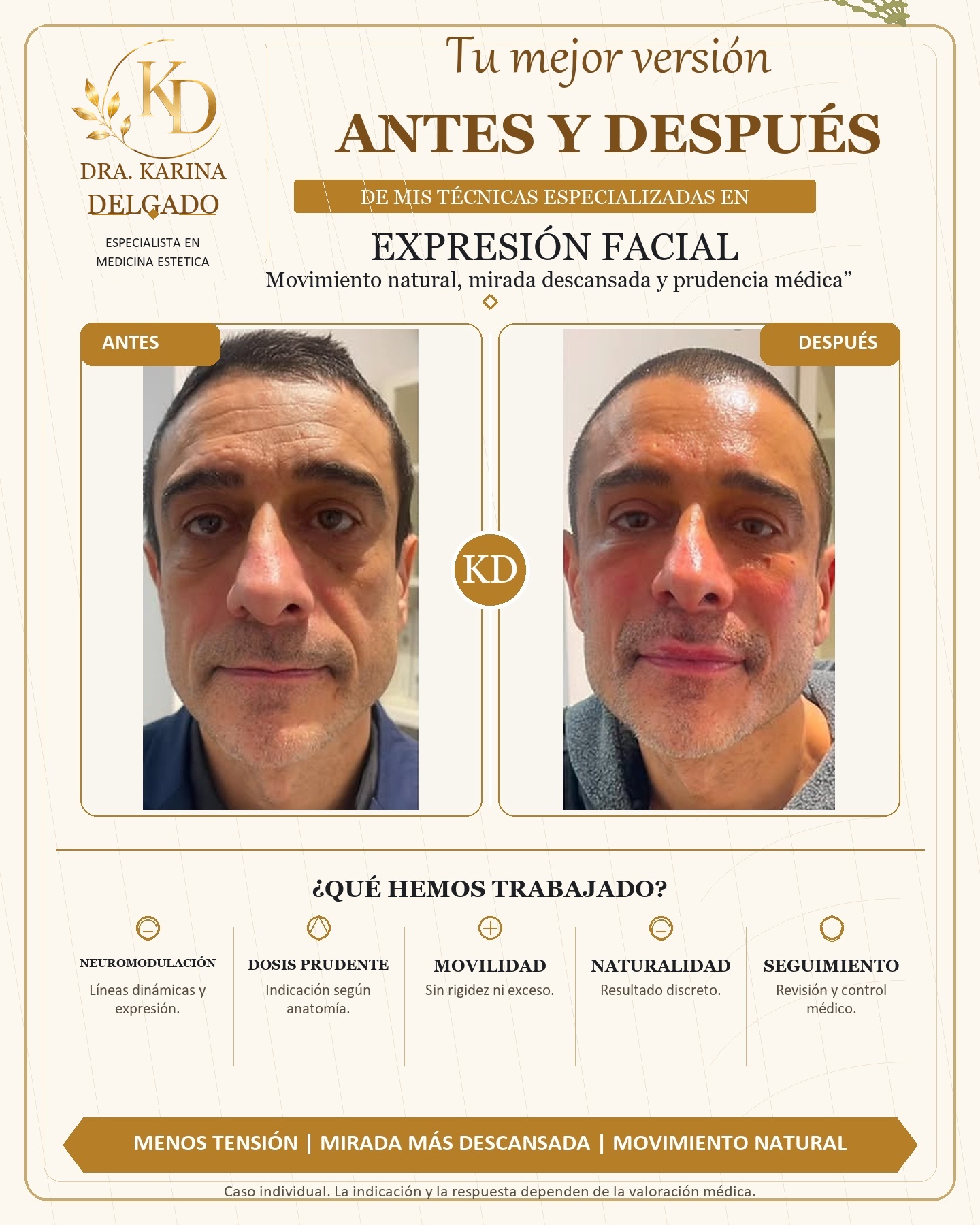 Caso real antes y despues de rejuvenecimiento facial masculino