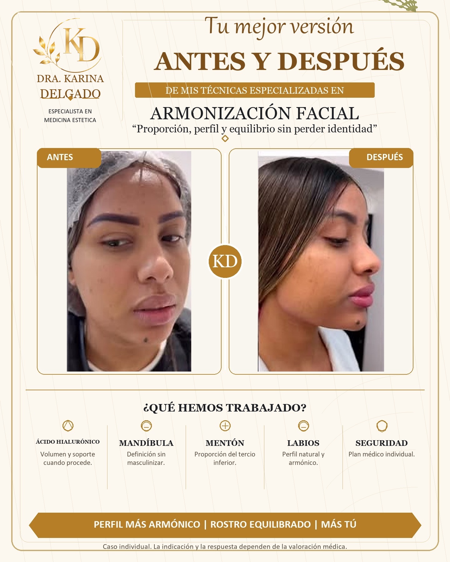 Caso real de perfilado facial y armonizacion