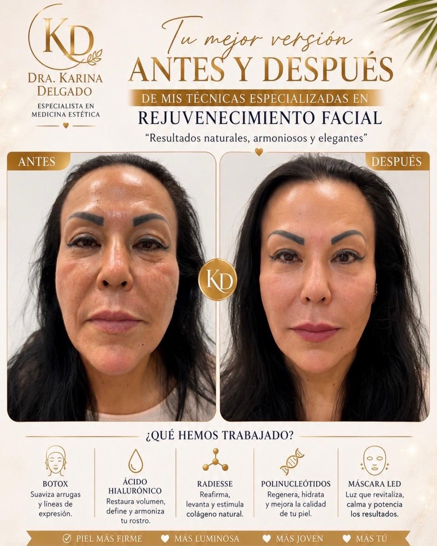 Caso real antes y despues de rejuvenecimiento facial integral